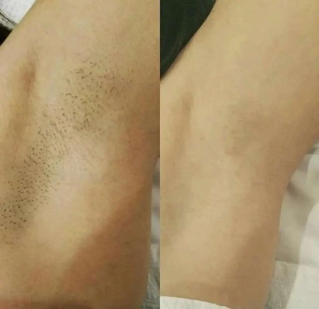 2 in 1 IPL Machine