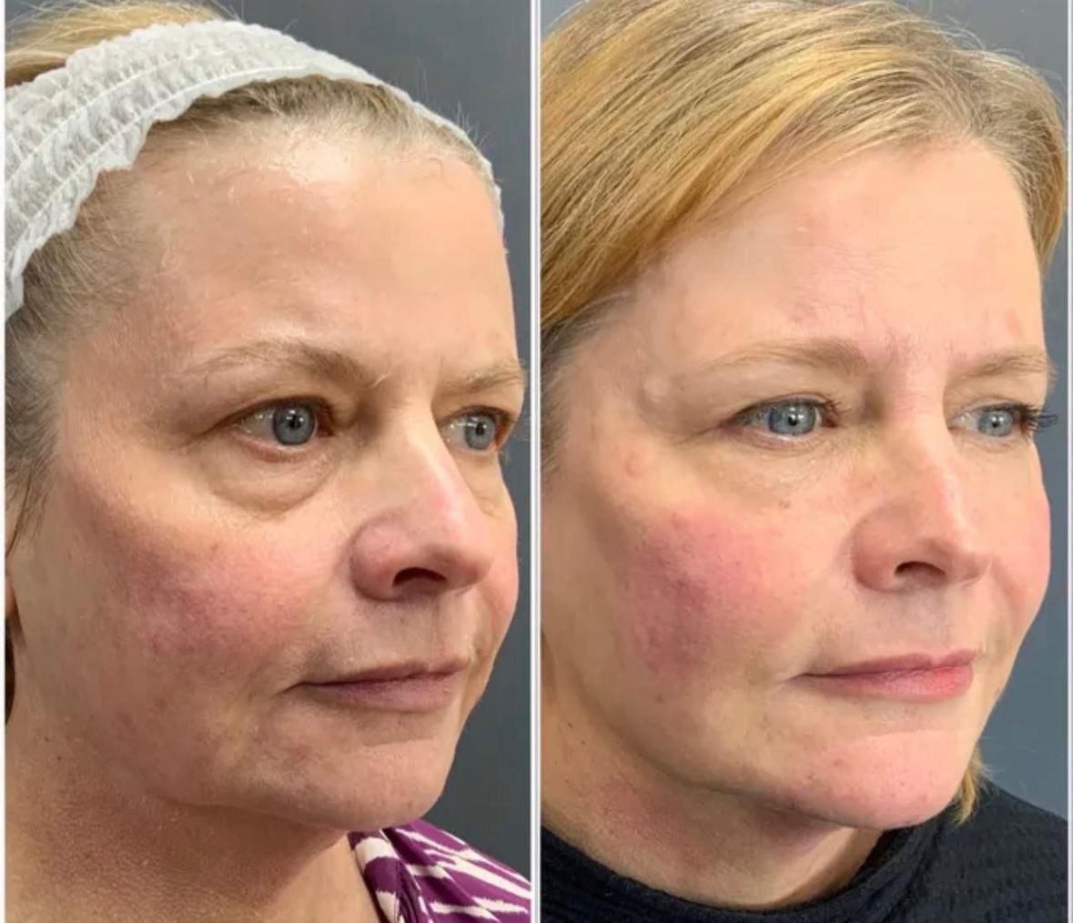 LumiLIFT LITE: 8D HIFU Device