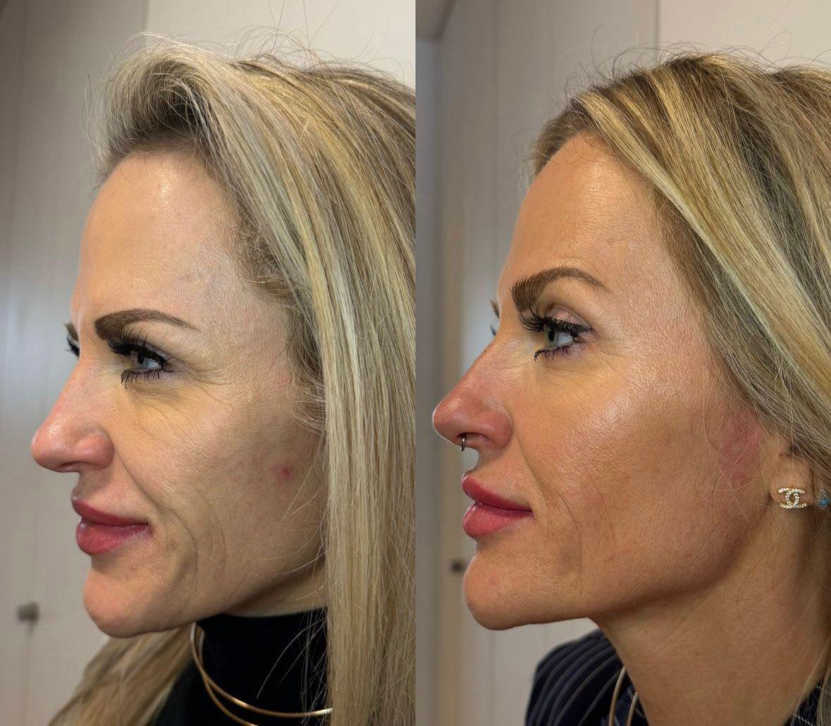 LumiLIFT LITE: 8D HIFU Device